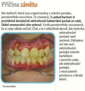 Příčina zánětu