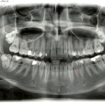 OPG, ortopantomogram
